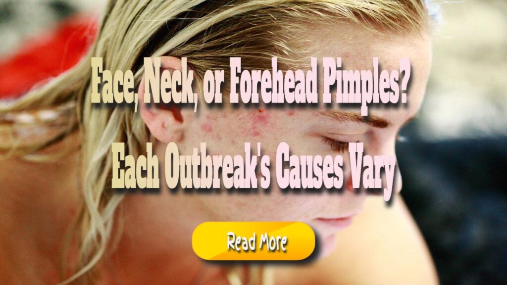 face neck or forehead pimples