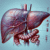 Liver Blood Test: Detailed Analysis Offered in Tewkesbury